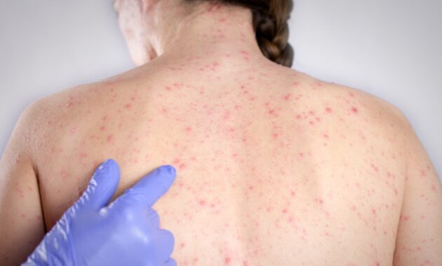 Measles cases rise globally: Know 5 signs and symptoms