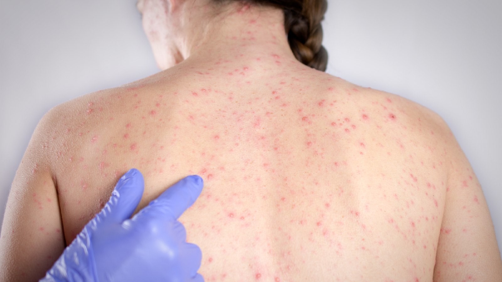 Measles cases rise globally: Know 5 signs and symptoms