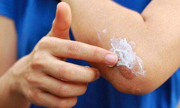 5 best antiseptic creams for wounds to heal faster