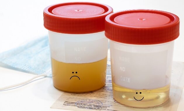 Causes and treatments of cloudy urine