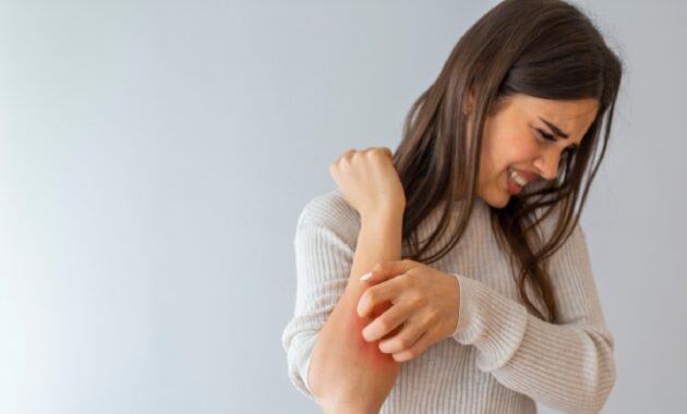 How to deal with psoriasis in winter: 7 expert tips