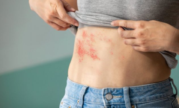 Shingles: Symptoms, causes, complications and treatment