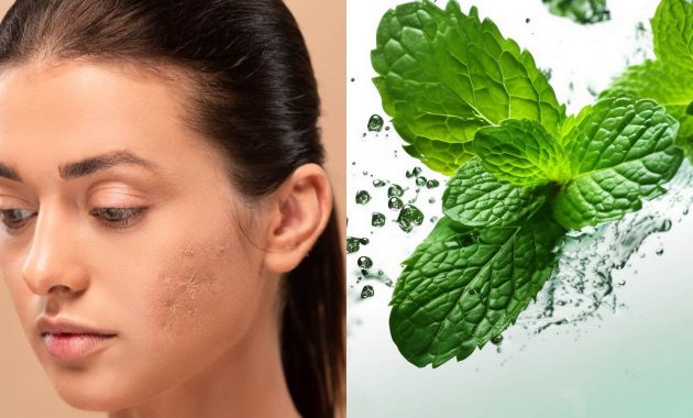 5 simple ways to use mint leaves to reduce acne scars