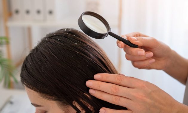 Home remedy for dandruff: Use egg and yogurt hair mask