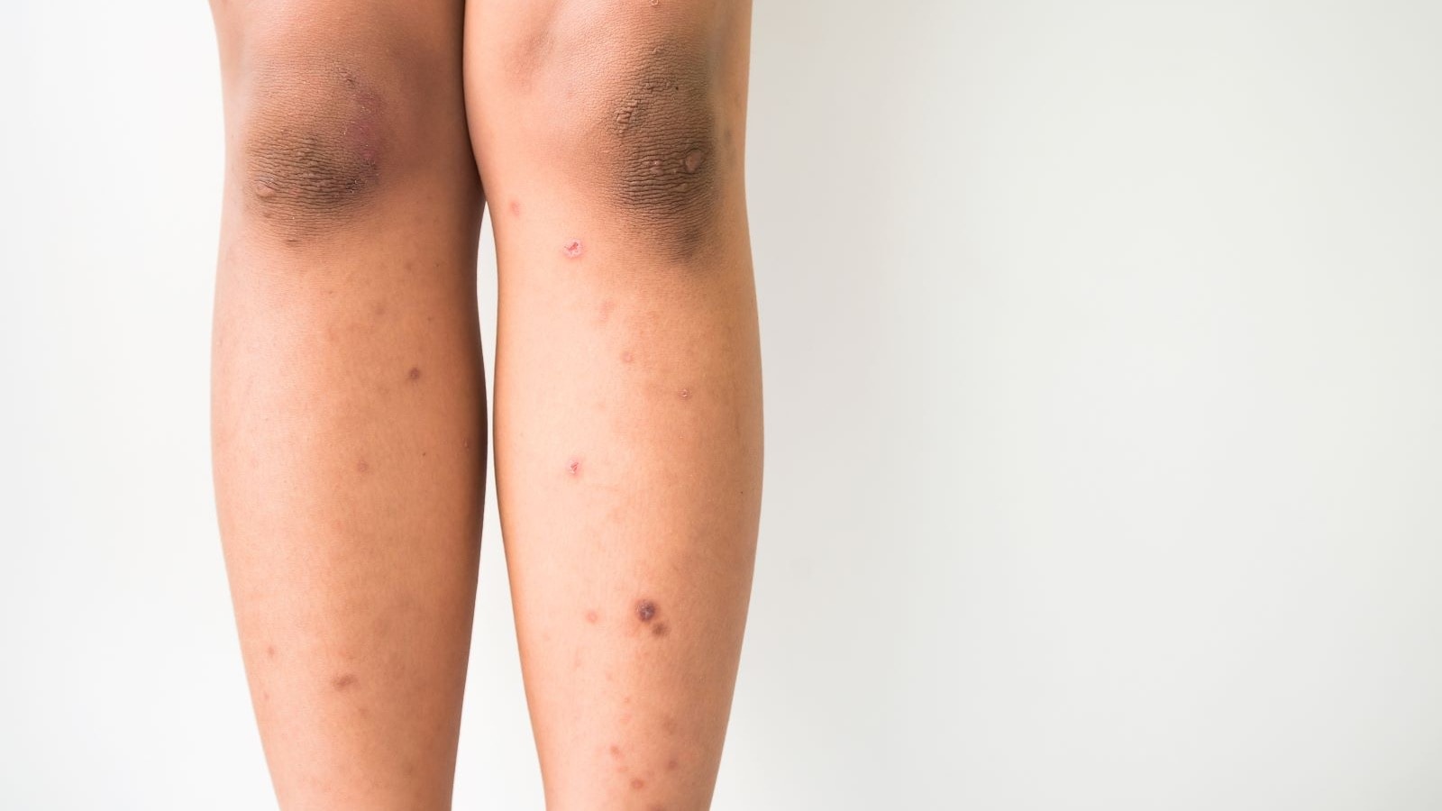 Dark spots on legs: Why does this happen and how to treat them