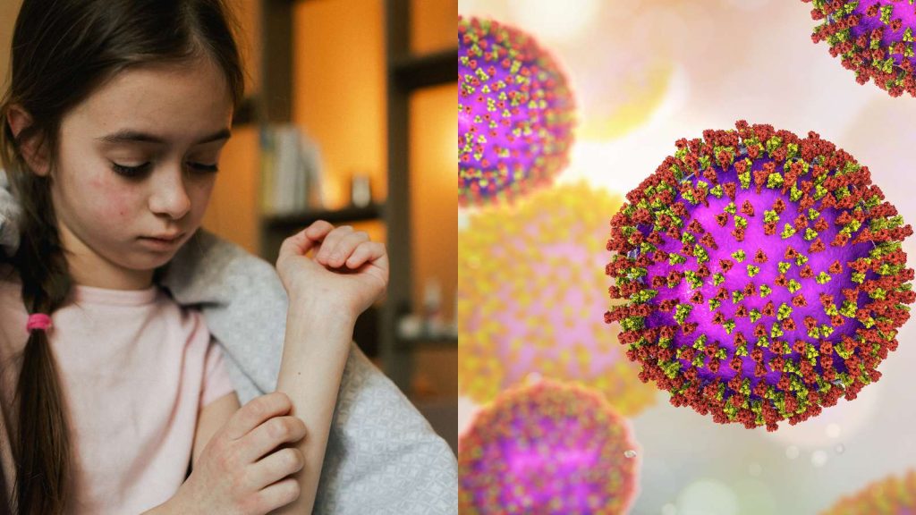 Measles outbreak in USA claims one life: Know symptoms and how to prevent it